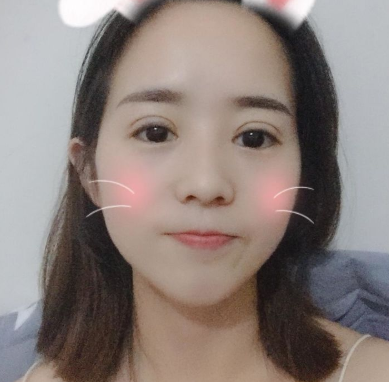 昆明医科大学第二附属医院能做双眼皮吗?案例