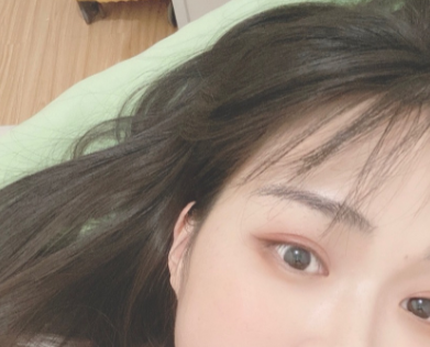 济南千佛山医院王彦主任做双眼皮怎么样?案例