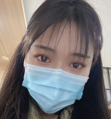 济南千佛山医院王彦主任做双眼皮怎么样?案例