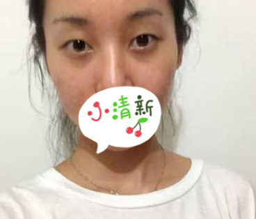 玉溪吴氏嘉美医美刘勤做双眼皮怎么样?案例