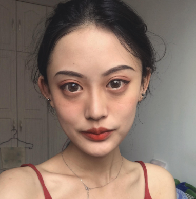重庆珂琳雅王陈自体脂肪全脸填充怎么样?案例