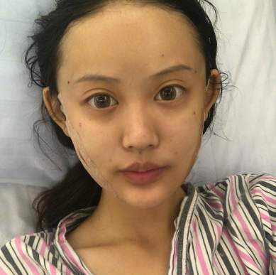 重庆珂琳雅王陈自体脂肪全脸填充怎么样?案例