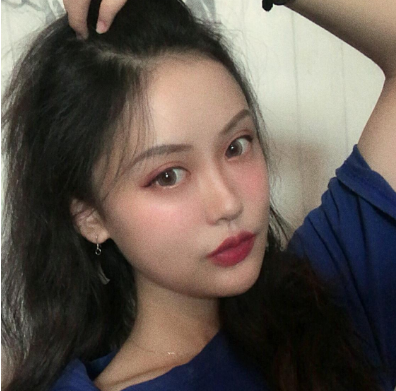 重庆珂琳雅王陈自体脂肪全脸填充怎么样?案例