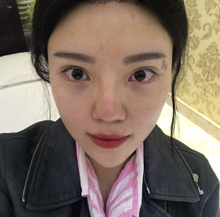 昆明美伊莱医疗医生周诚鼻部手术案例分享!
