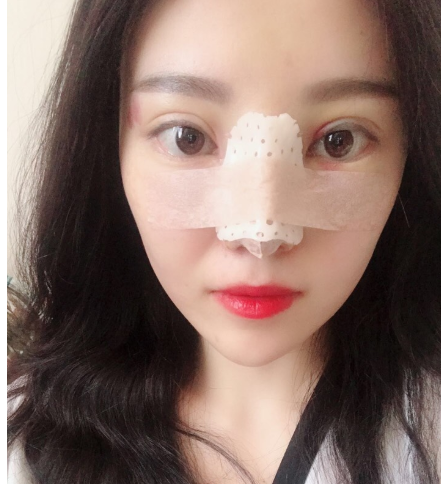 昆明美伊莱医疗医生周诚鼻部手术案例分享!