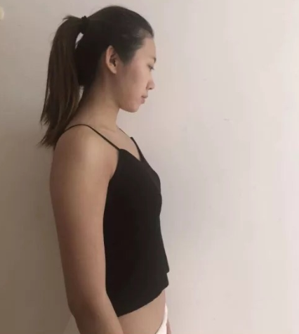 北京美莱医疗美容假体隆胸果怎么样?