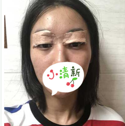 玉溪吴氏嘉美医美刘勤做双眼皮怎么样?案例