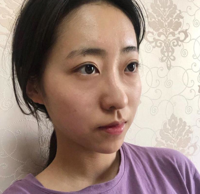 广东韩妃医疗美容医院程宁新鼻部手术案例分享