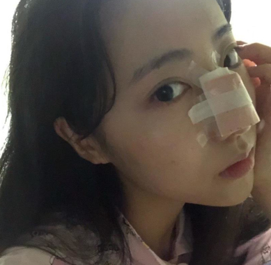 广东韩妃医疗美容医院程宁新鼻部手术案例分享