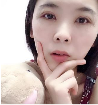 宁波嘉莱美整形齐强做双眼皮咋样呢?案例|点评