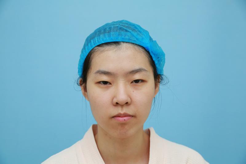北京延世医疗美容诊所双眼皮技术怎么样?案例