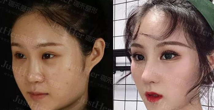葛志鑫和任东鼻部手术谁做的更好?案例|点评