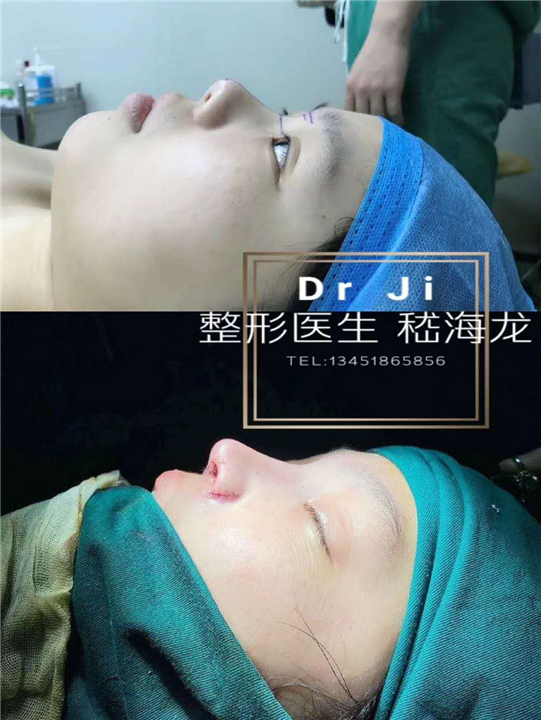 嵇海龙做鼻子技术怎么样?案例|点评