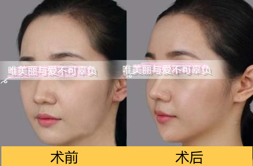 嵇海龙做鼻子技术怎么样?案例|点评