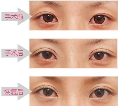 上海哪个地方双眼皮修复重新做的医生好?