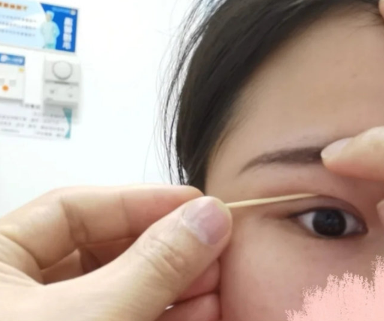 龙岗中心医院肖兴东双眼皮做得怎么样?案例,