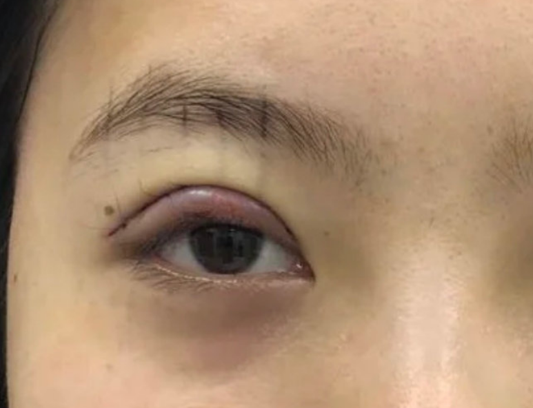 龙岗中心医院肖兴东双眼皮做得怎么样?案例,