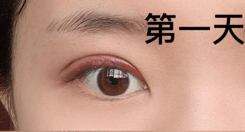 青岛盈海王波涛主任做双眼皮怎么样?案例|点评