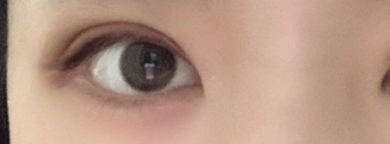 青岛盈海王波涛主任做双眼皮怎么样?案例|点评