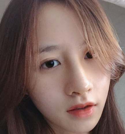 芜湖壹加壹医疗美容鼻部手术案例分享！