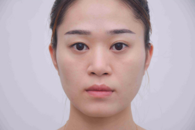 四川美莱医学美容医院肋软骨隆鼻案例分享!