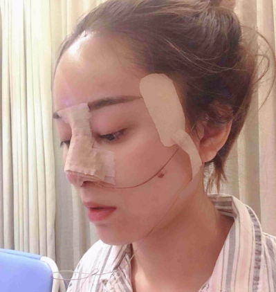 四川美莱医学美容医院肋软骨隆鼻案例分享!