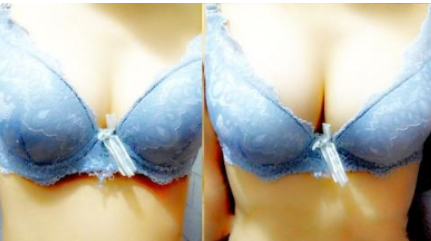 自体脂肪隆胸你真的了解吗?