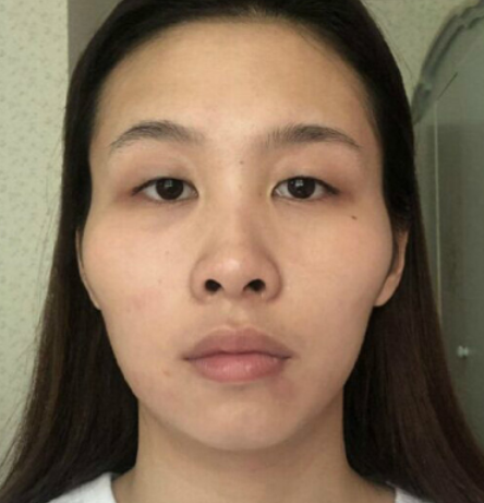四川友谊医院张立天颧骨内推怎么样?案例|点评