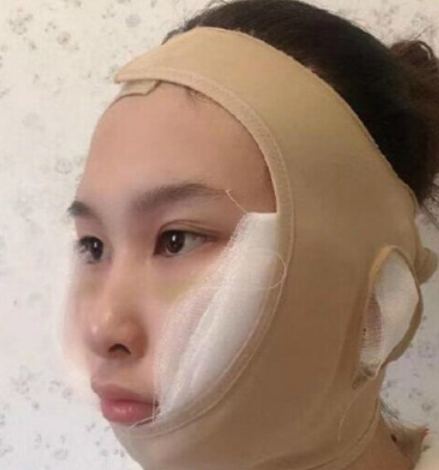 四川友谊医院张立天颧骨内推怎么样?案例|点评