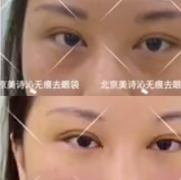 北京美诗沁韩雪做祛眼袋手术果怎么样?