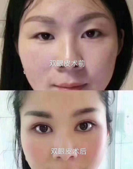 石家庄蓝山唐春香做双眼皮怎么样?