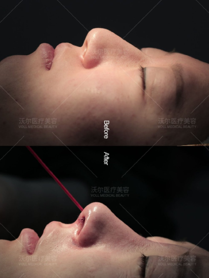北京沃尔刘彦军做鼻子怎么样?