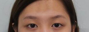 上海九院苏薇洁做双眼皮怎么样?
