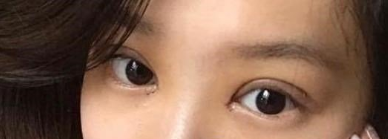 上海九院苏薇洁做双眼皮怎么样?