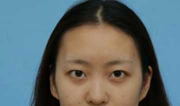 上海九院魏皎隆鼻审美怎么样?