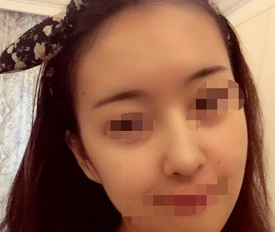上海九院魏皎隆鼻审美怎么样?