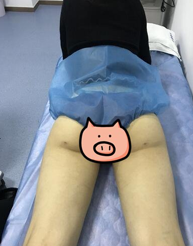 上海九院曹卫刚抽脂技术怎么样?