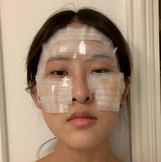 上海九院曹卫刚脂肪填充技术怎么样?