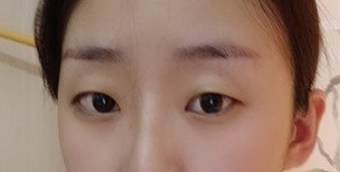 西安西京医院整形科肖博割双眼皮技术怎么样?