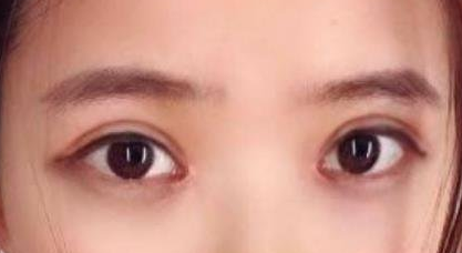 北京八大处整形医院靳小雷割双眼皮果怎么样