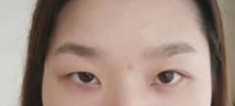 武汉协和医院整形科做双眼皮怎么样?