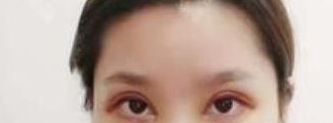 武汉协和医院整形科做双眼皮怎么样?