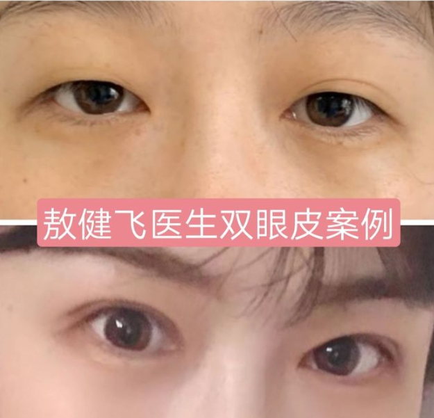 北京中日友好医院整形科怎么样?双眼皮果