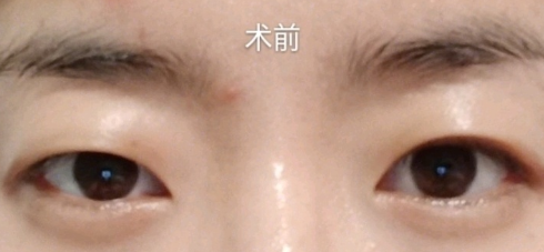 上海九院周一雄割双眼皮多少钱?果怎么样?