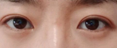 上海九院周一雄割双眼皮多少钱?果怎么样?