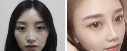 以前北京美莱的那个宫风勇做鼻子技术怎么样？