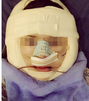 成都素美卢元刚做鼻子怎么样,有没有失败案例
