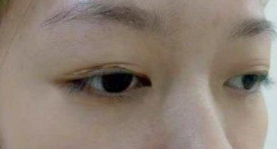 沈阳杏林美容整形医院做双眼皮怎么样?