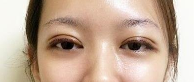 沈阳杏林美容整形医院做双眼皮怎么样?