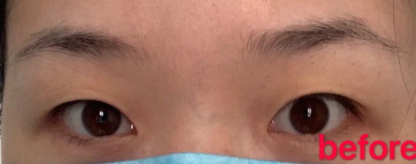北京八大处整形医院郭时伟医生双眼皮怎么样?
